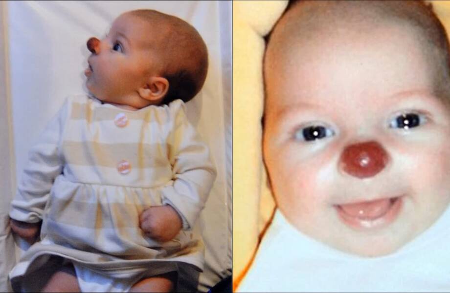 Pige med en klovnenæse. Hvordan gik babyens skæbne ud?